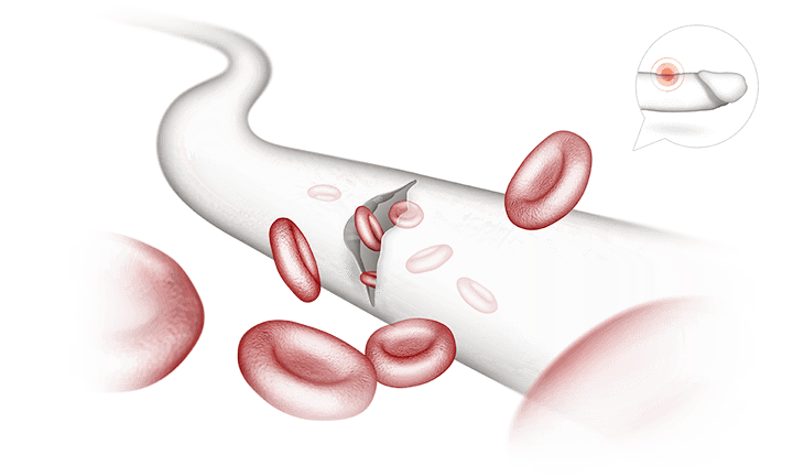 Peyronie’s Disease